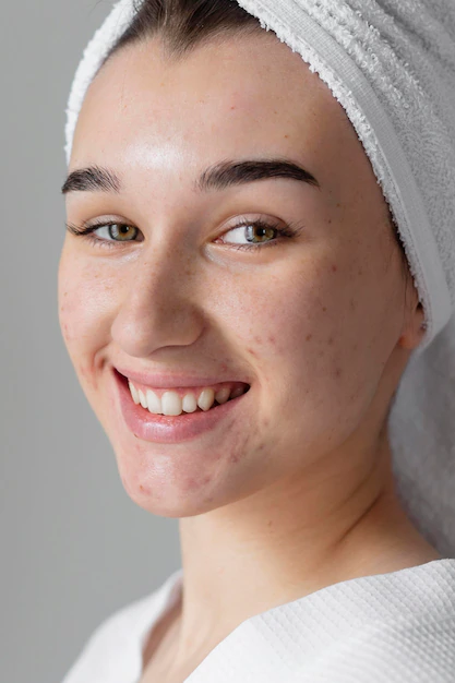 REMOVING ACNE SCARS